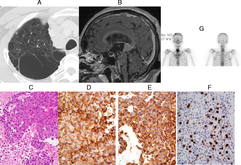 Clinicopathological analysis in patients with neuroendocrine tumors