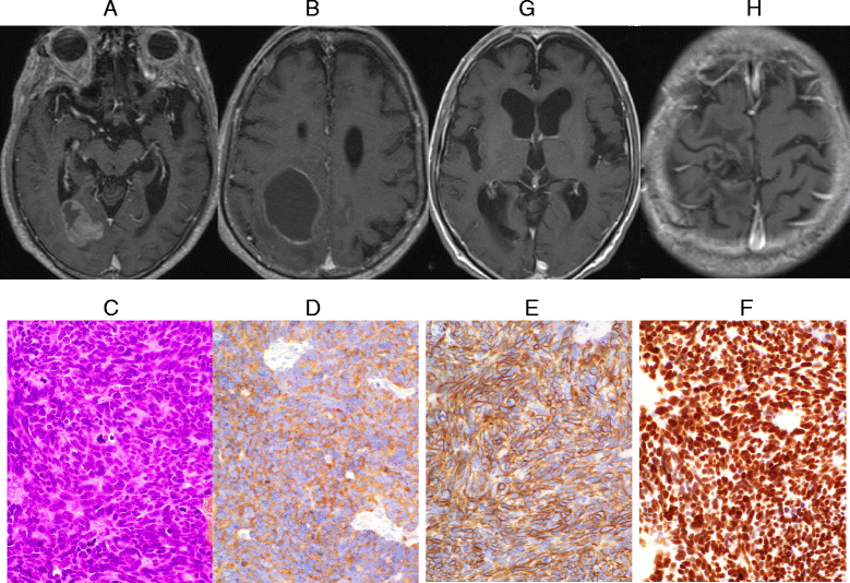 Clinicopathological analysis in patients with neuroendocrine tumors