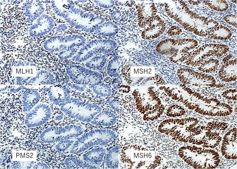 Карта мш. Ген msh2. Mlh1, msh2, msh6, pms2, EPCAM, MSI. Позитивная реакция опухолевых клеток msh2 msh6 pms2 mlh1. Pms2.
