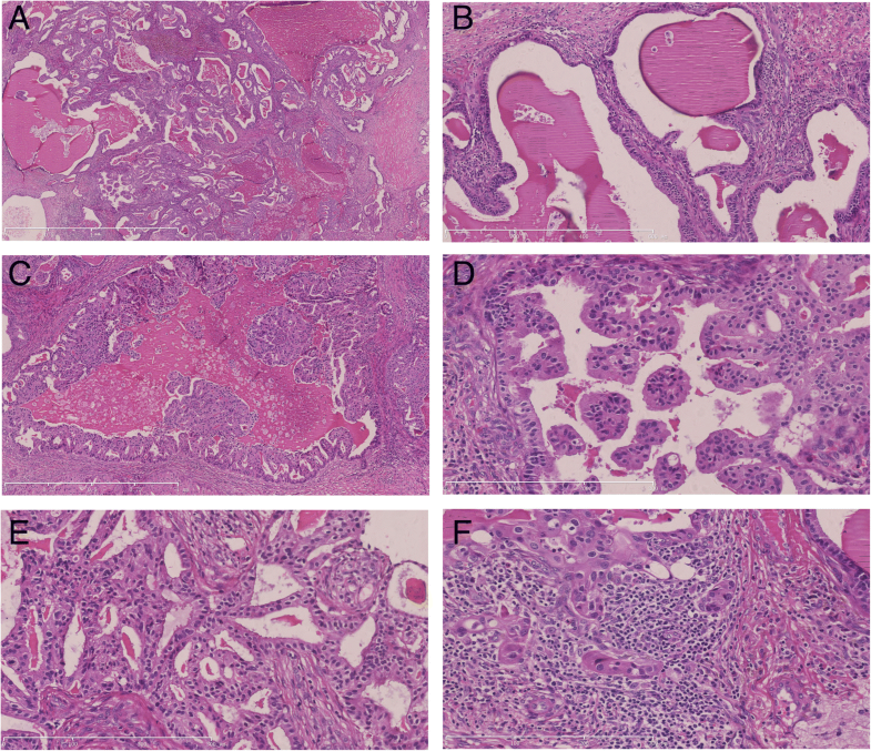 Invasive cystic hypersecretory carcinoma of the breast a rare variant