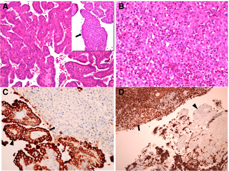 BRAF gene mutations in synchronous papillary thyroid carcinoma and