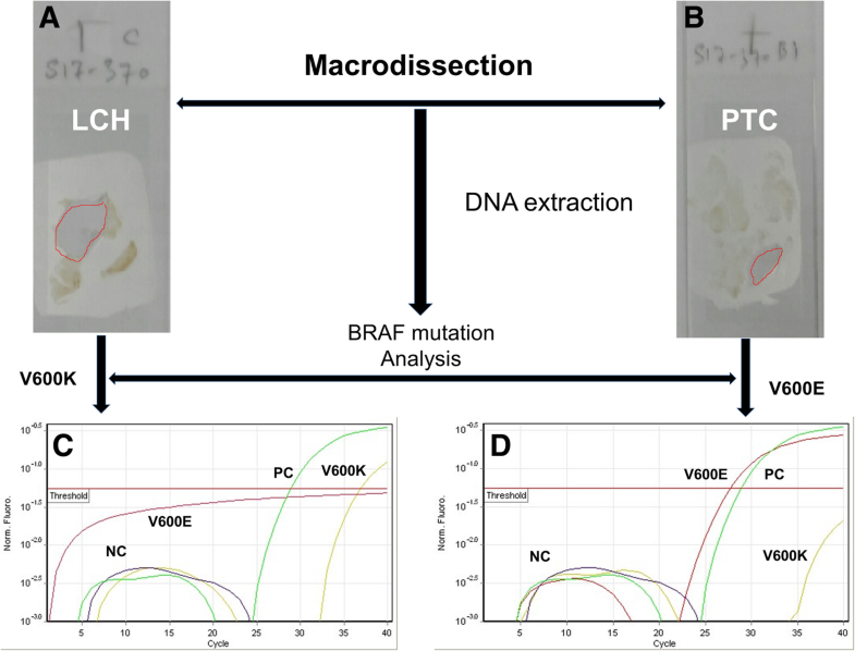 BRAF gene mutations in synchronous papillary thyroid carcinoma and