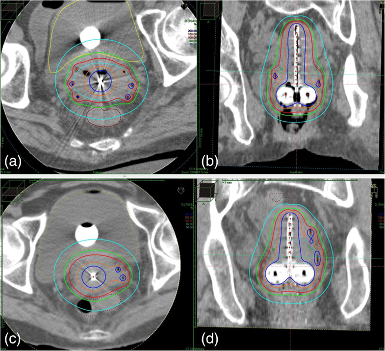 A hybrid technique of intracavitary and interstitial brachytherapy for