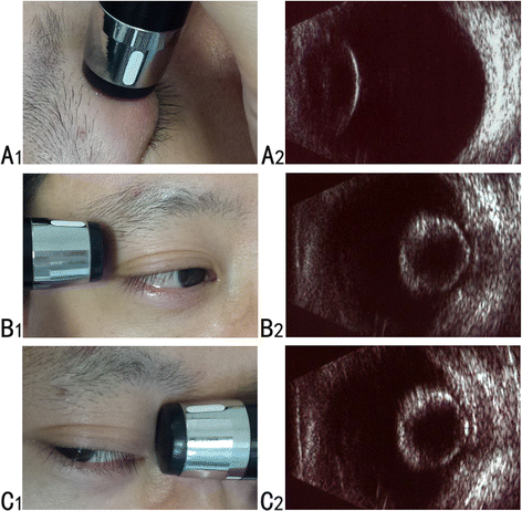 Role Of B-scan Ultrasonography In The Localization Of Intraocular ...