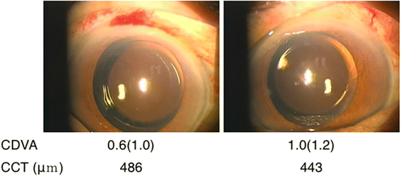Extensive bilateral corneal edema 6 weeks after cataract