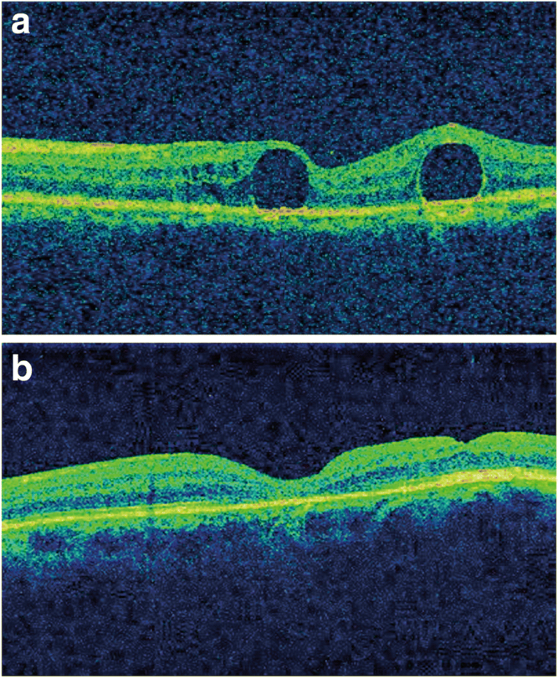 Surgical removal of submacular perfluorocarbon liquid with a 38gauge