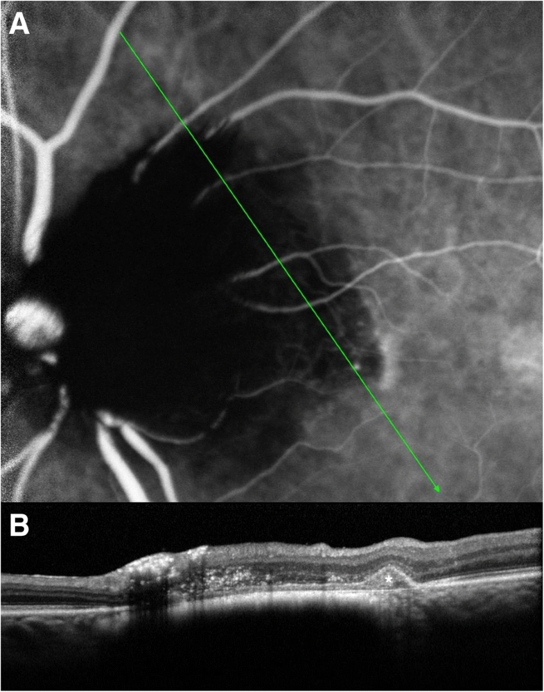 Optic disk melanocytoma associated with polypoidal choroidal