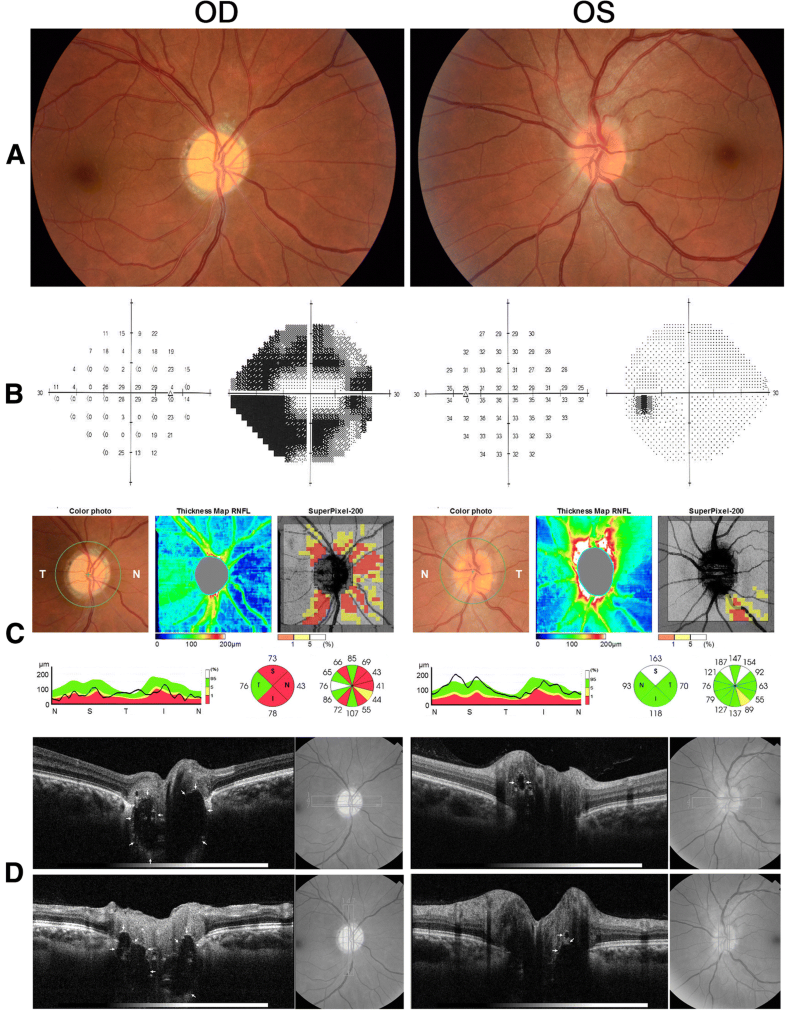 Acute visual loss and optic disc edema followed by optic atrophy in two