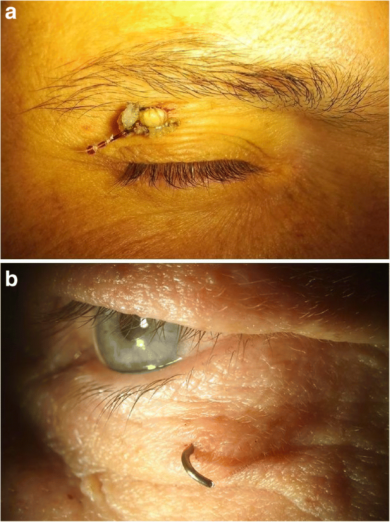 Open globe and eyelid injuries from fish hooks BMC