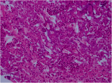 Hepatic paragonimiasis in a 15-month-old girl: a case ...