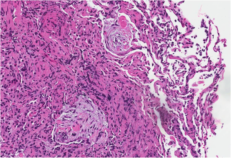 A rare case report of polyangiitis overlap syndrome