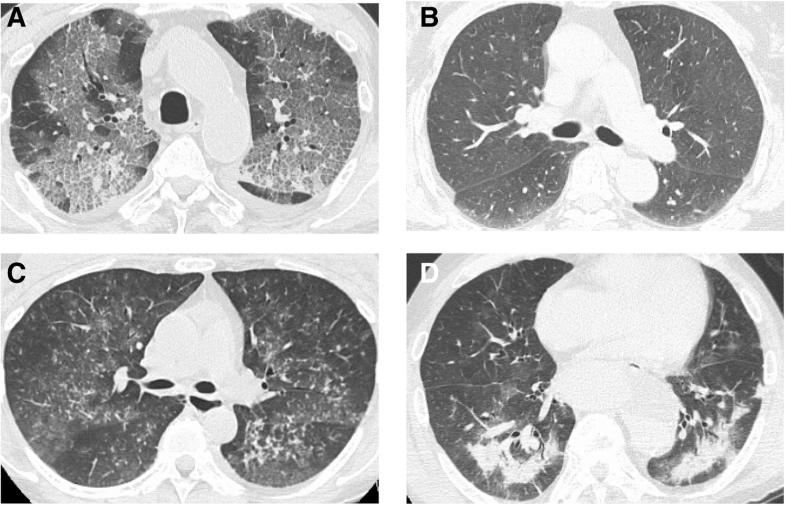 Prognostic significance of crazy paving ground grass opacities in non ...