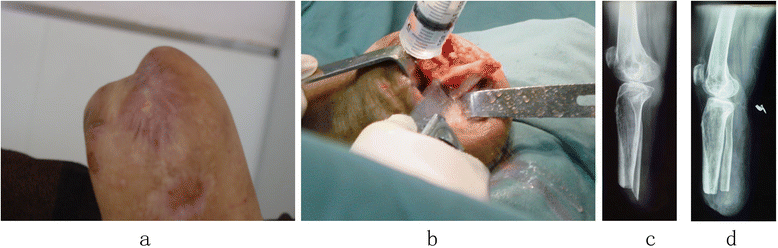 Surgical revision for stump problems after traumatic above-ankle