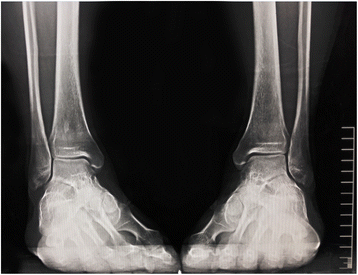 Posterolateral Ankle Ligament Injuries Affect Ankle Stability A