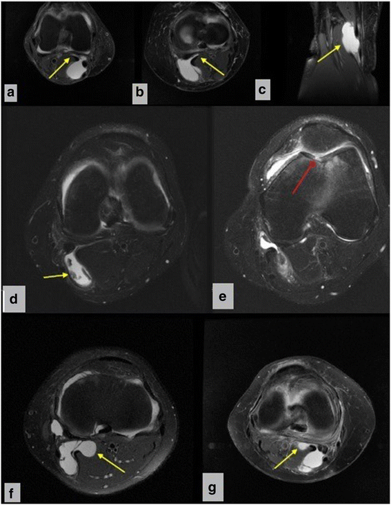 Treatment of baker cyst, by using open posterior cystectomy and supine arthroscopy on