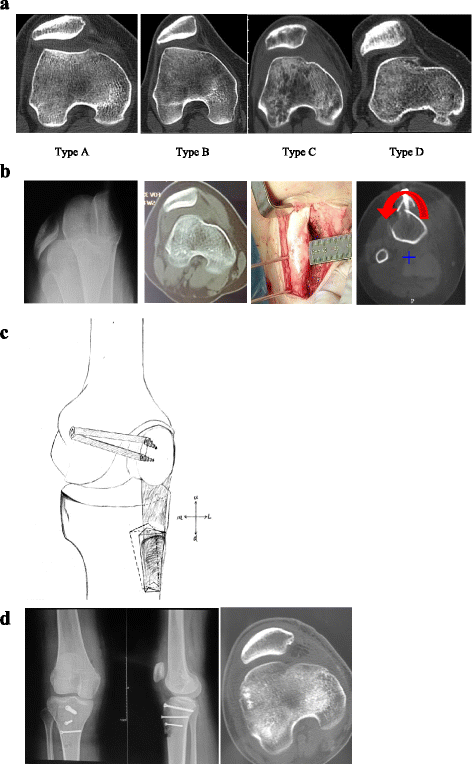 The outcomes of the modified Fulkerson osteotomy procedure to treat