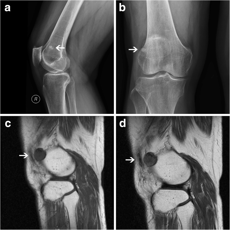 The diagnosis and arthroscopic treatment of angioleiomyoma presenting