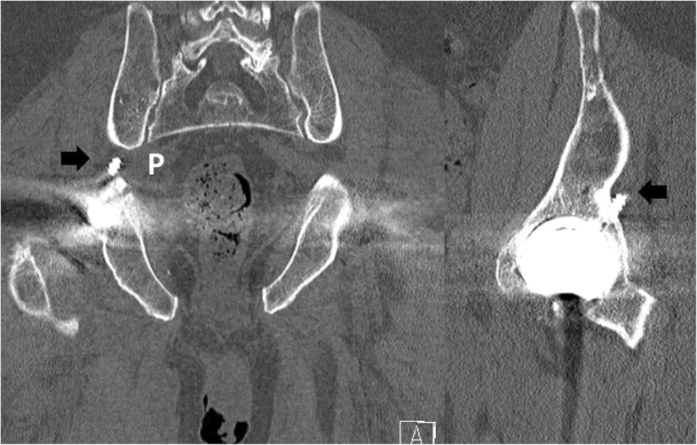Endoscopic resection of acetabular screw tip to sciatic