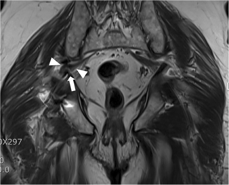 Endoscopic resection of acetabular screw tip to sciatic