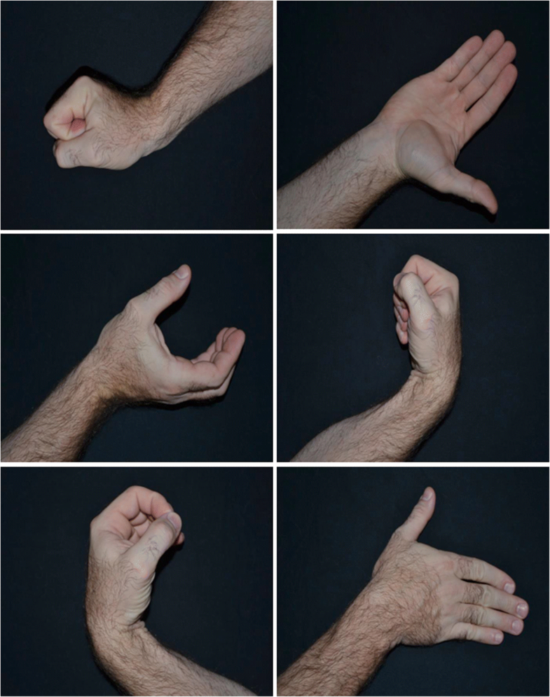 Graded motor imagery for women at risk for developing type I CRPS