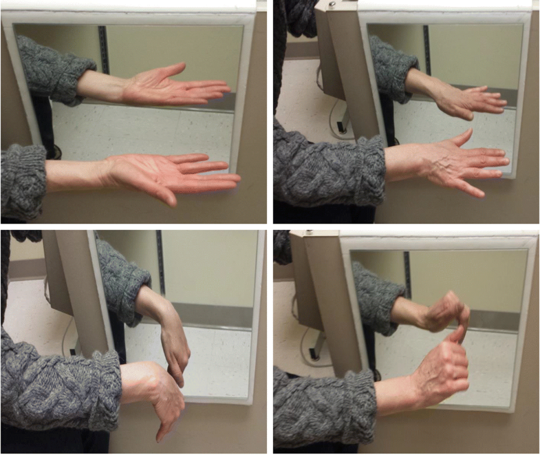 Graded motor imagery for women at risk for developing type I CRPS