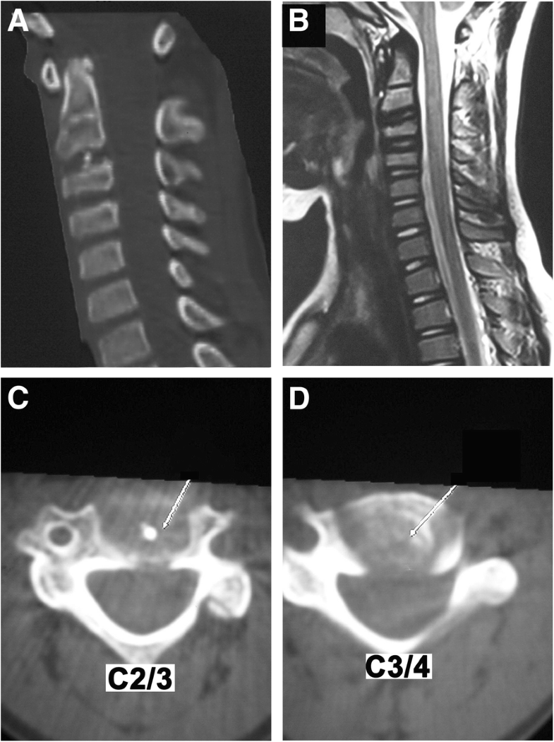 Calcification of the intervertebral disc and ossification of posterior