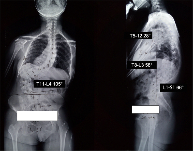 Kyphoscoliosis treatment adults image