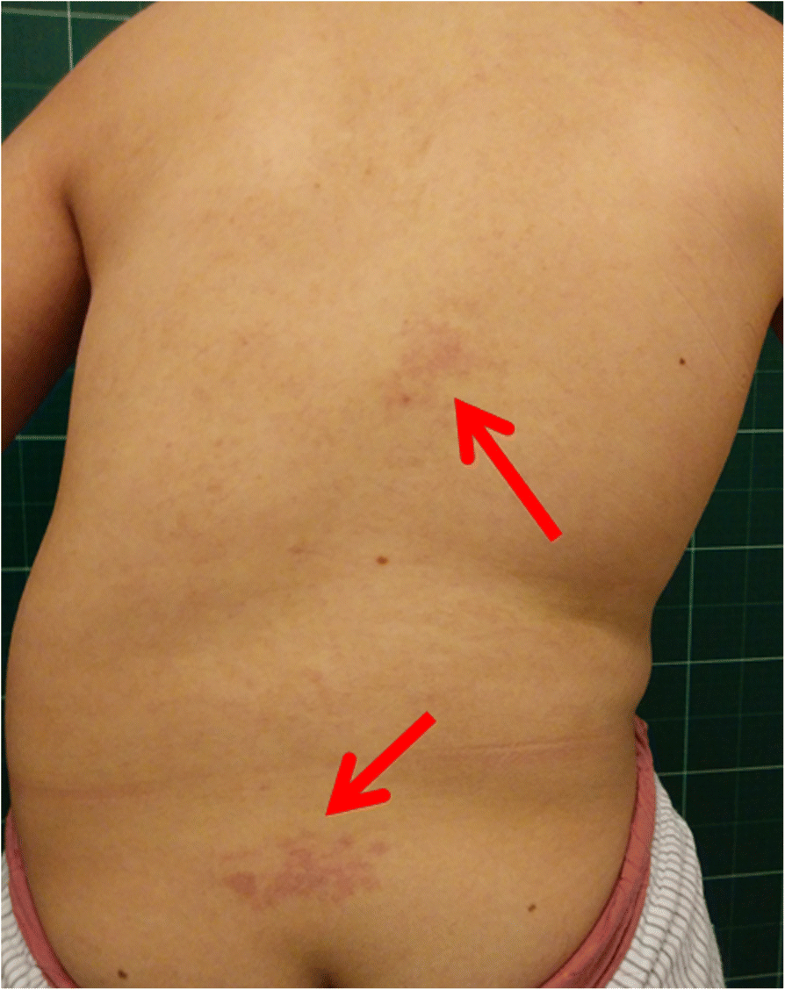 Kyphoscoliosis complications image