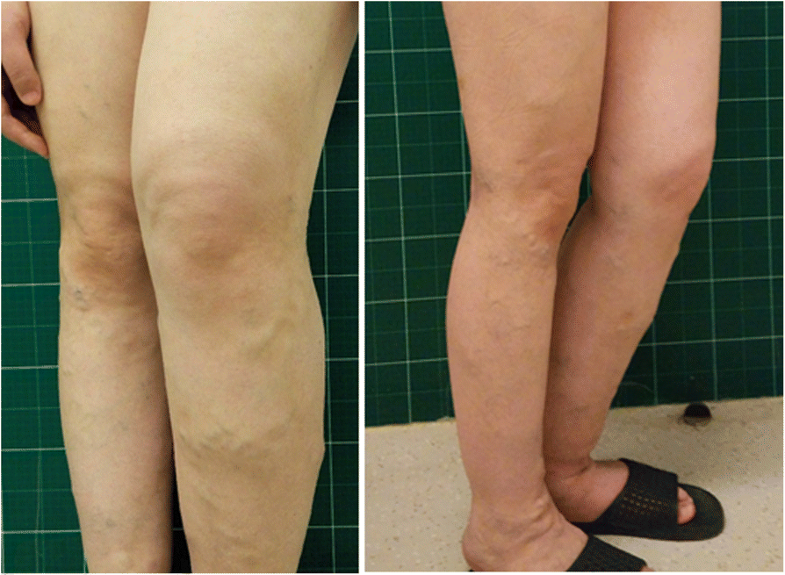 Kyphoscoliosis treatment picture