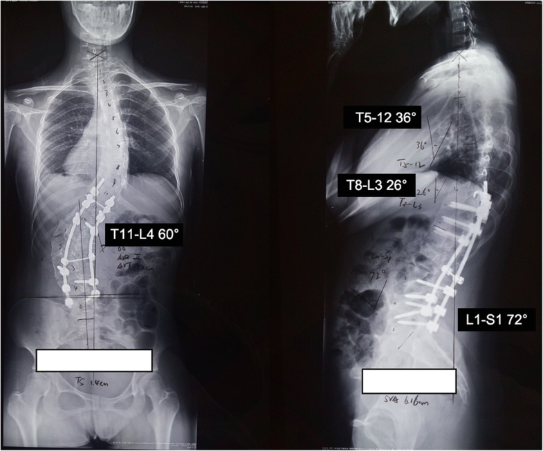 Kyphoscoliosis literature review image