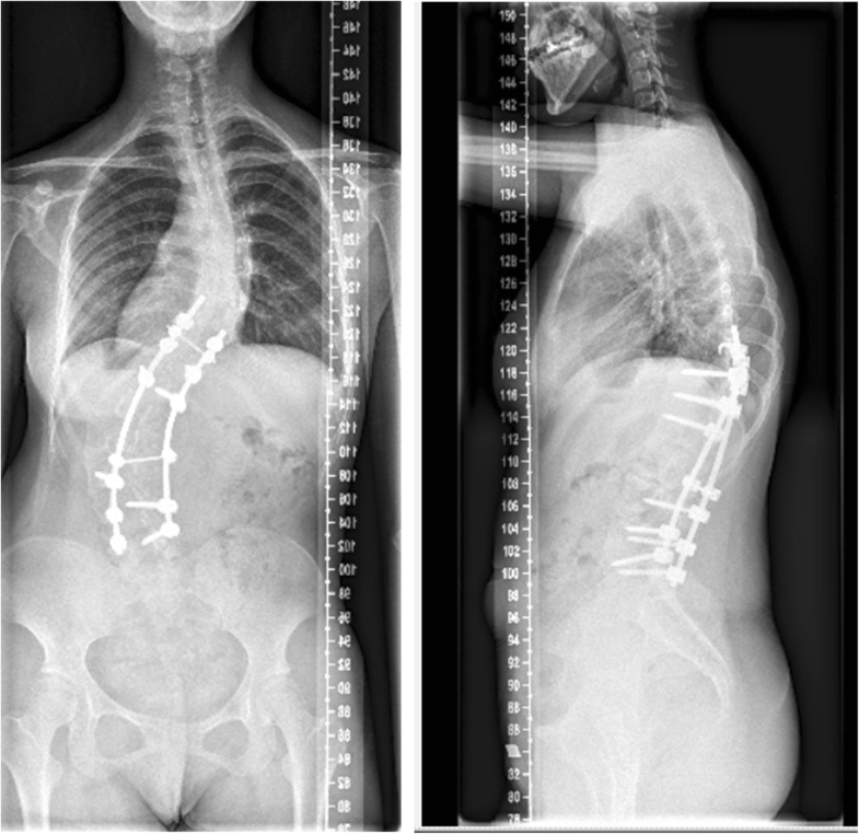 Kyphoscoliosis life expectancy picture