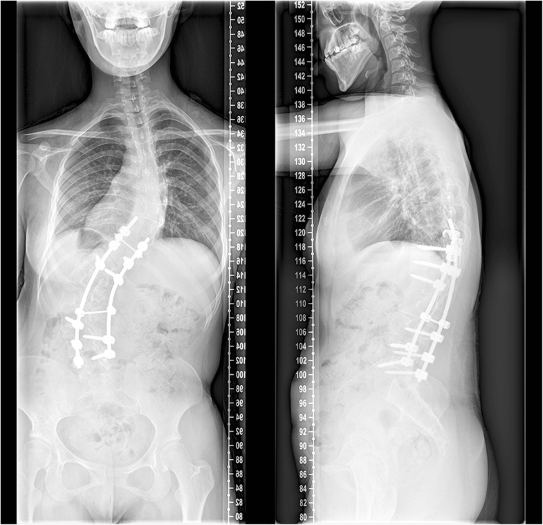 Kyphoscoliosis restrictive lung disease picture