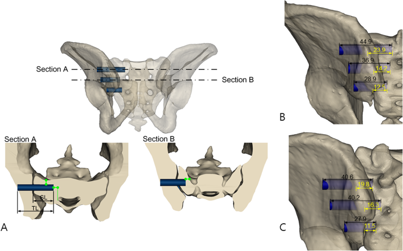 Technical variation of trans-articular sacroiliac joint (SIJ) fusion ...