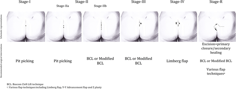 bascom cleft lift bascom cleft lift