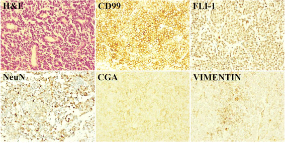 Download Homer Wright Rosettes Ewing Sarcoma Pictures