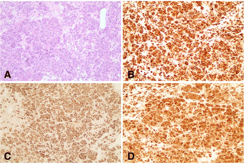 A rare case of pure testosteronesecreting adrenal adenoma in a