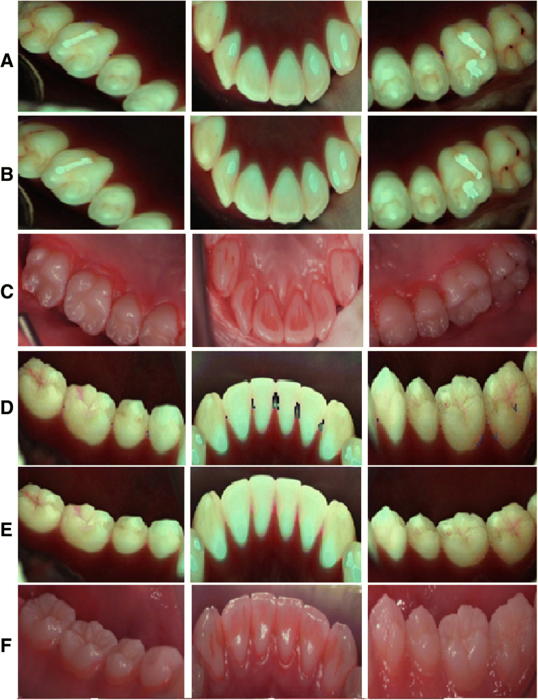 Validity assessment of quantitative lightinduced fluorescencedigital