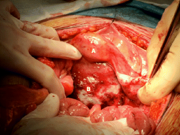 exam ovarian cancer for Recto septum and cystadenocarcinoma: case vaginal report a