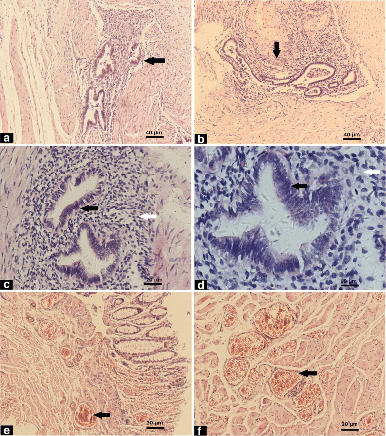 Endometriosis in the rectum by hemorrhoids leading to