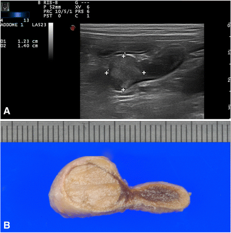 enlarged adrenal gland symptoms in dogs enlarged adrenal gland symptoms in dogs