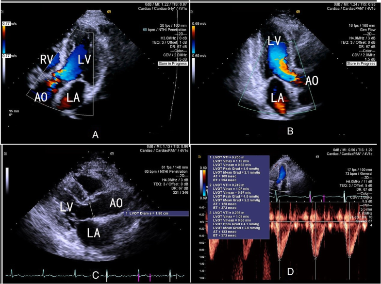 Reliability of threedimensional color flow Doppler and twodimensional