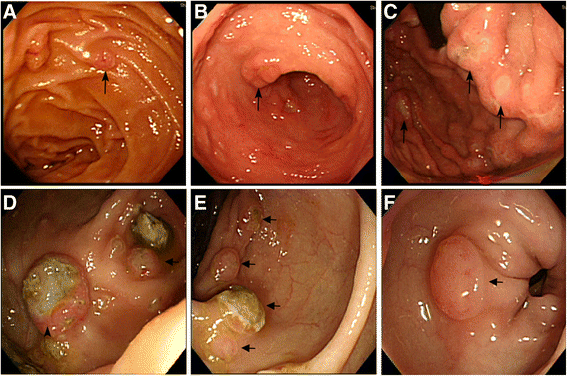 Gastrointestinal metastasis from primary sarcomatoid carcinoma of the