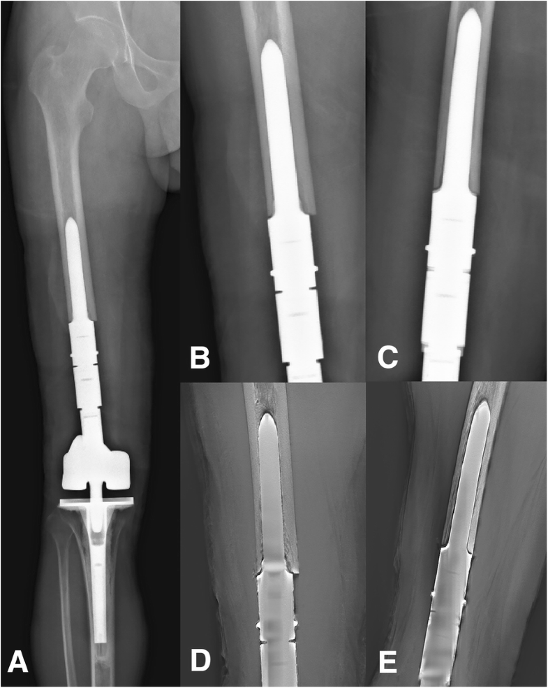 Uncemented, curved, short endoprosthesis stem for distal femoral