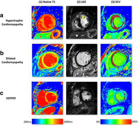 t1 mapping ecv cardiac fig