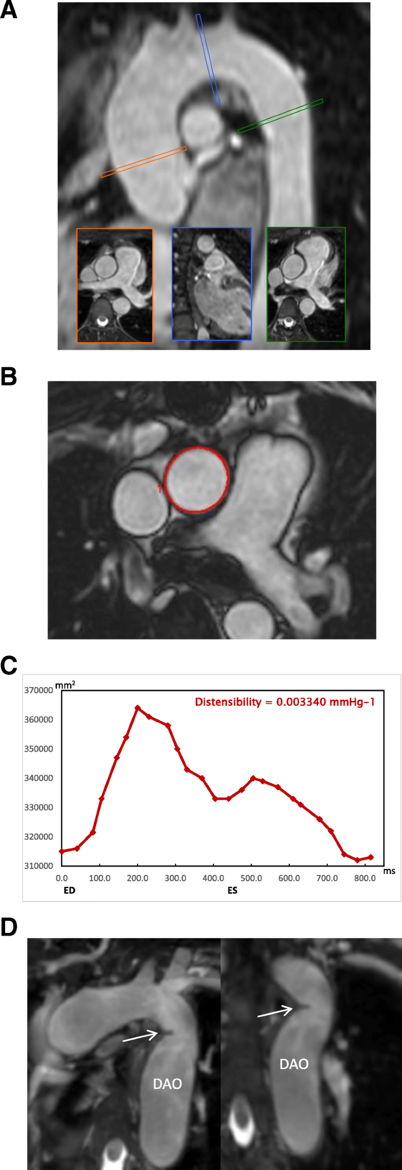 Impaired aortic distensibility and elevated central blood pressure in