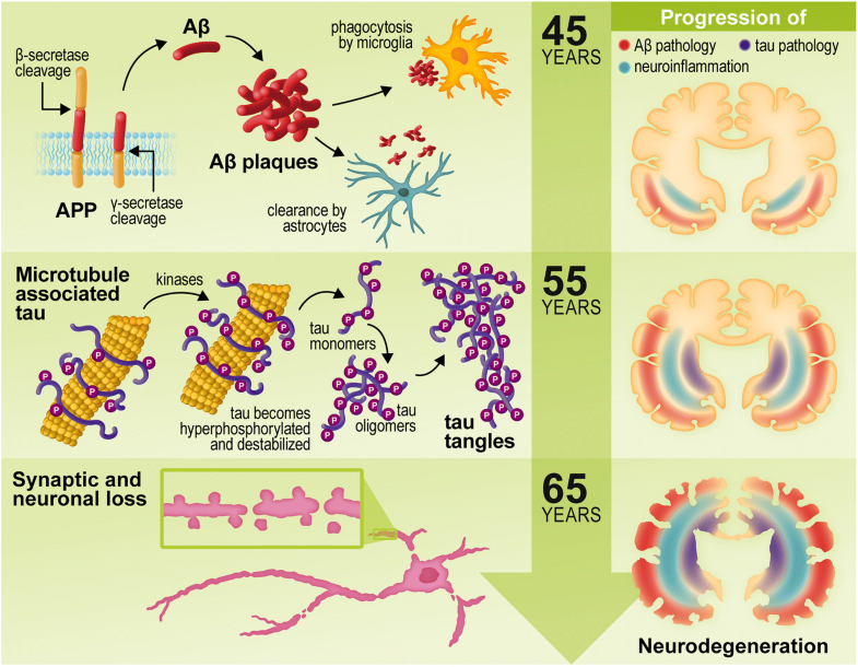 Inflammation the link between comorbidities, and Alzheimer’s