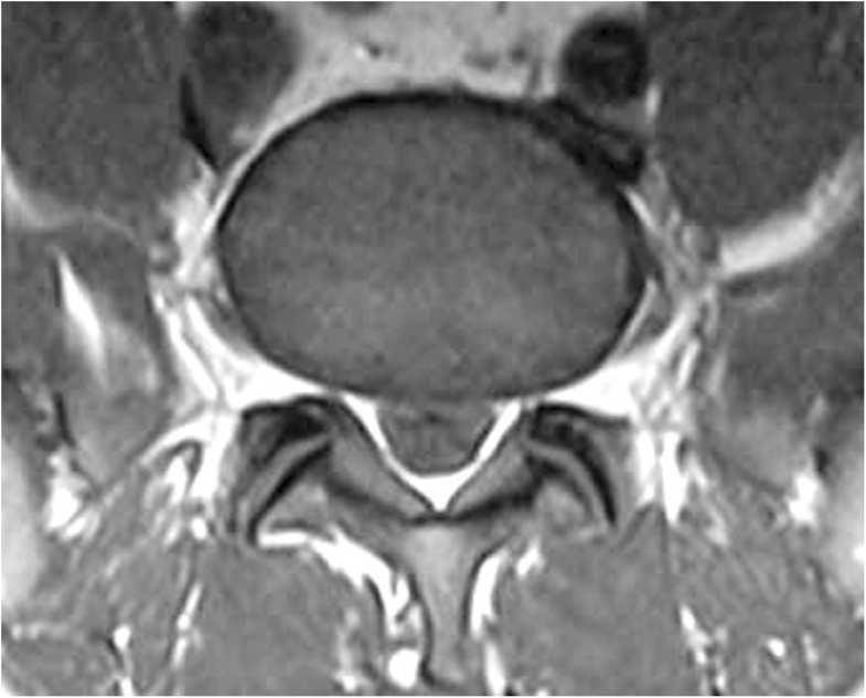 Spinal epidural lipomatosis presenting to a U.S. Veterans