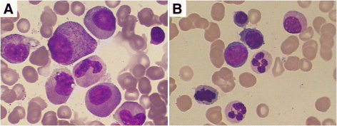 Histiocytic sarcoma combined with acute monocytic leukemia: a case ...