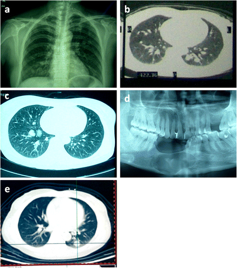 Malignant ameloblastoma (metastatic ameloblastoma) in the lung: 3 cases
