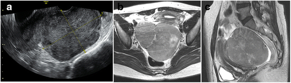 Rapid growth of mitotically active cellular fibroma of the ovary: a ...
